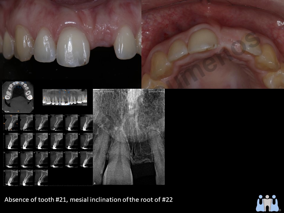 Guided Implantology