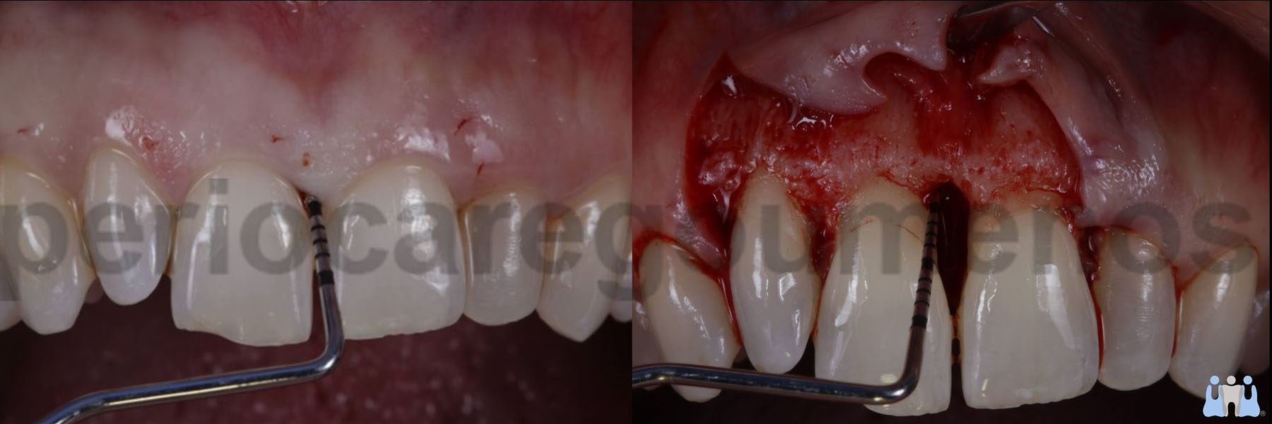 Surgical treatment of an infrabony lesion on tooth #11