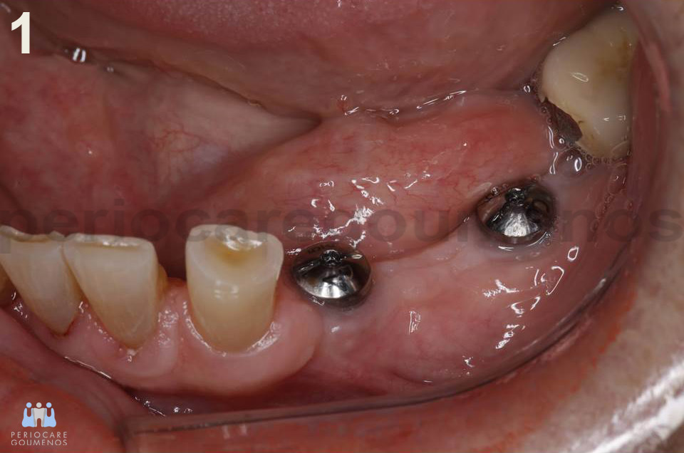 Difficulty in removal of a healing abutment