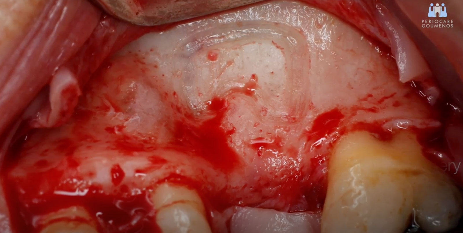 Combining the Sinus Elevation procedure with buccal GBR