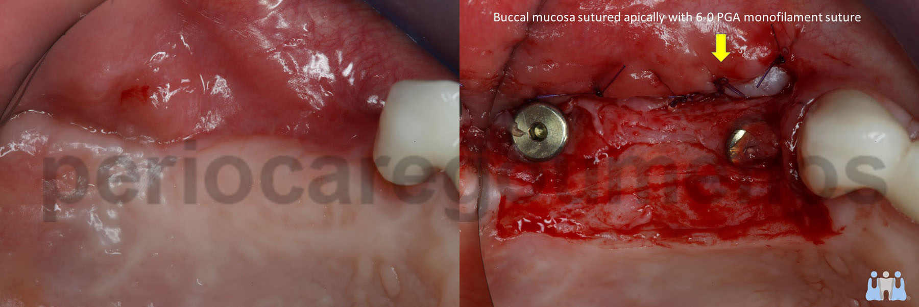 Implant uncoverage in the posterior mxilla