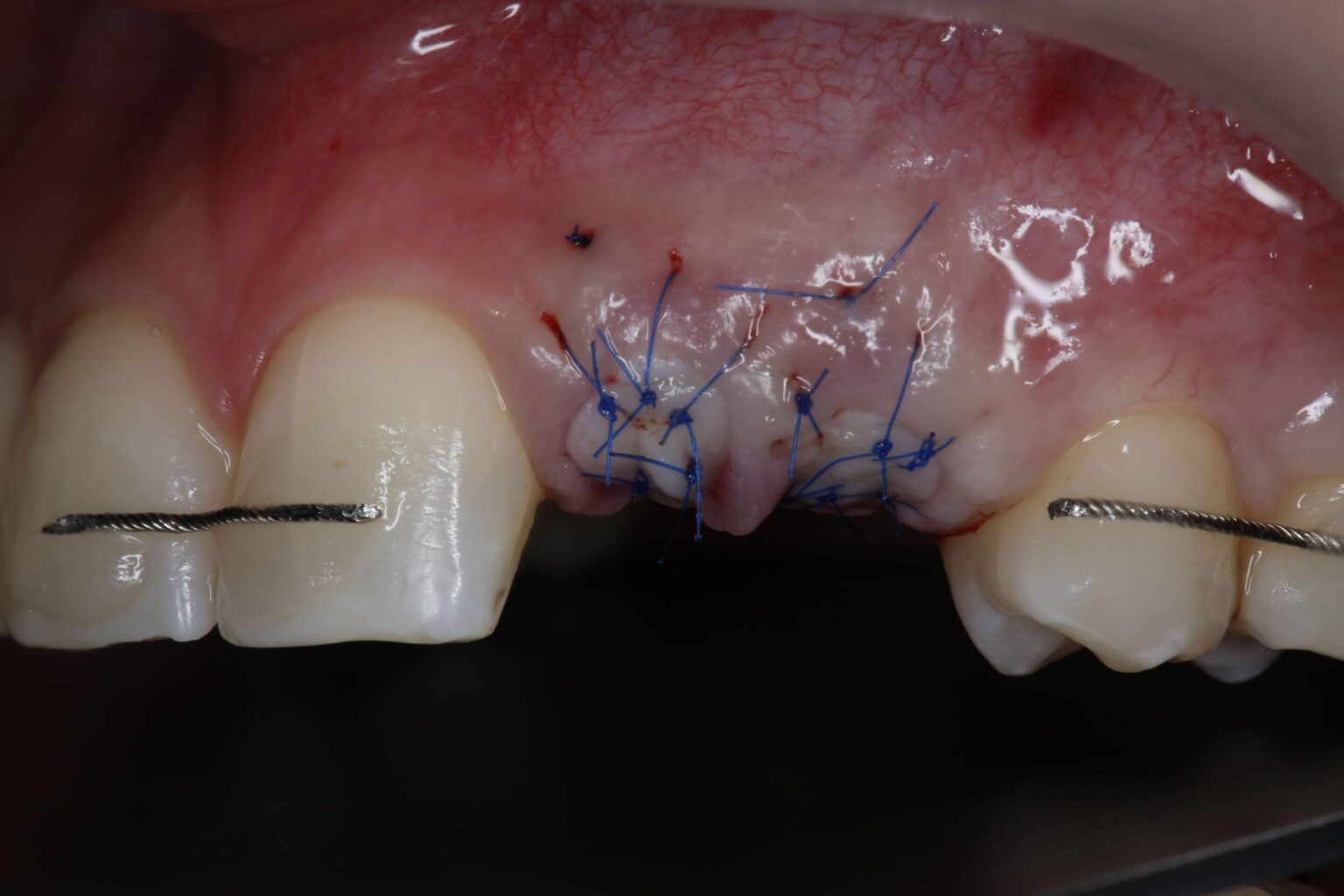 Ridge preservation with BDDM and free mucosal graft - pgedu - Periocare ...