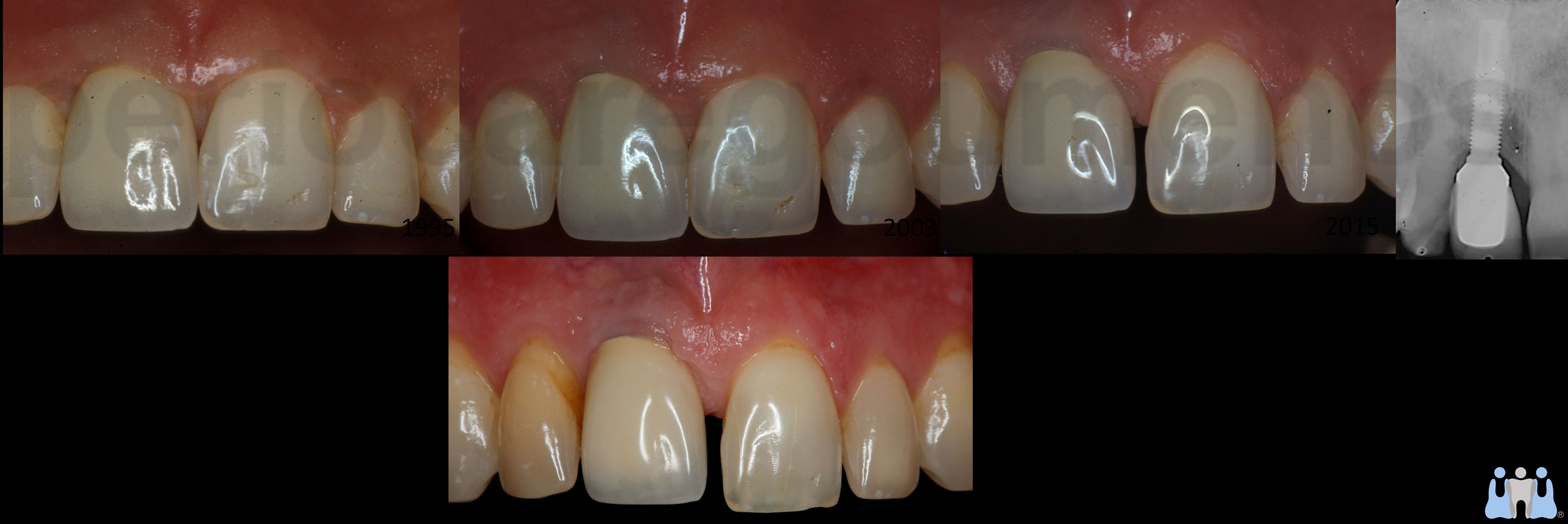 Questioning the past aesthetic outcome in contemporary Implantology