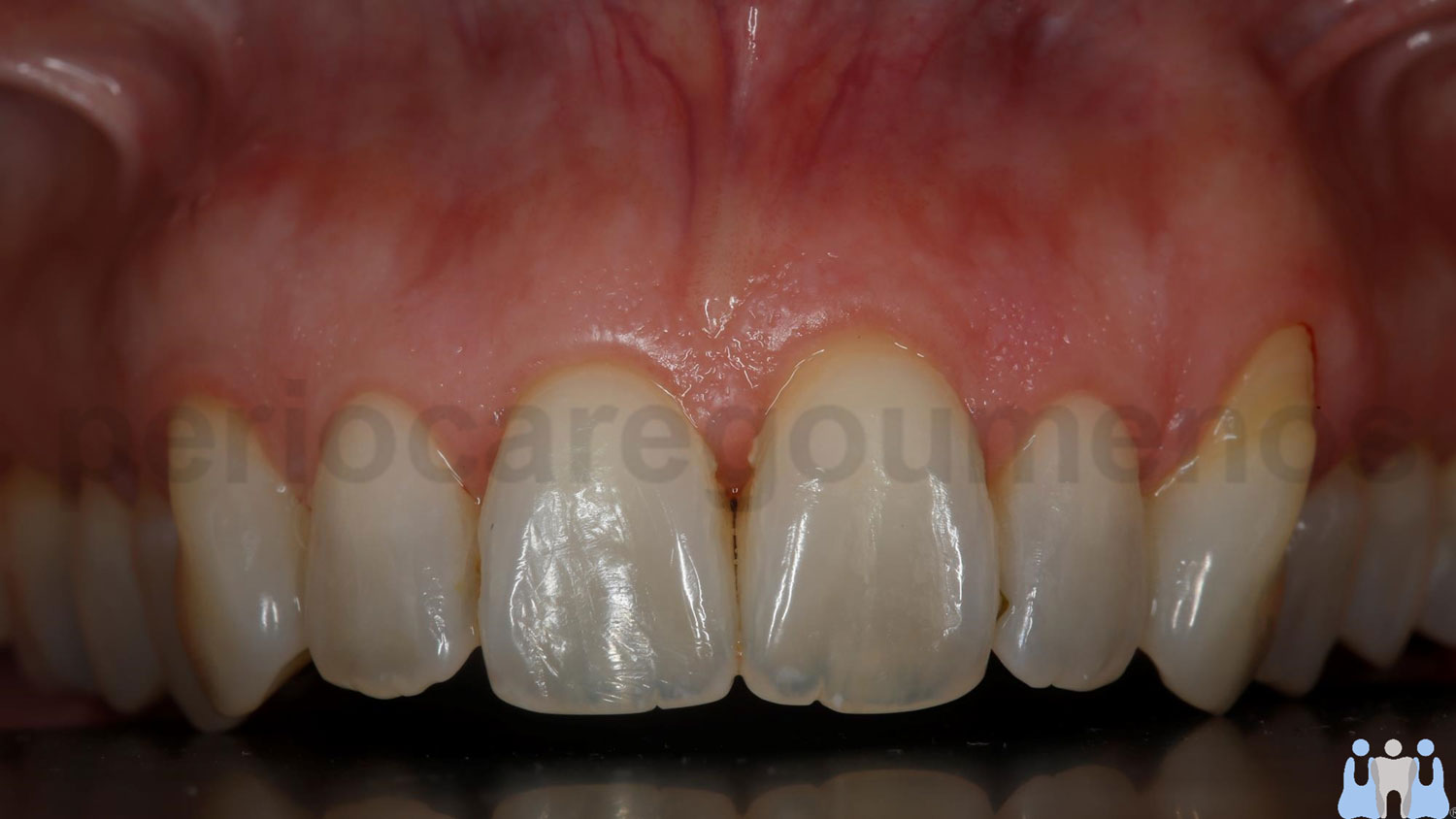 Root coverage with the combination of CTG and Coronally Advanced Flap