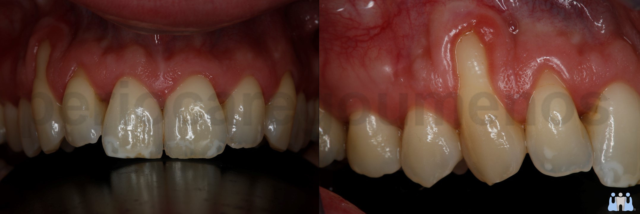 Root coverage using the double papillae flap in combination with CTG