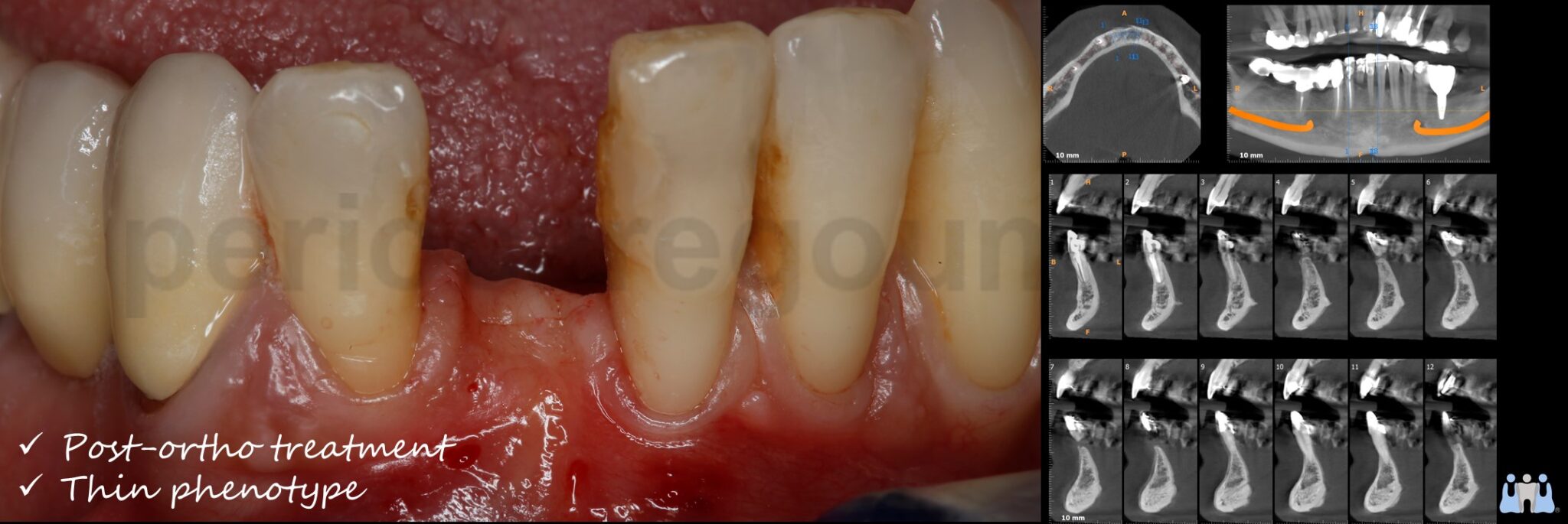 Hard and Soft tissue management during implant installation and uncoverage in an unfavorable ridge