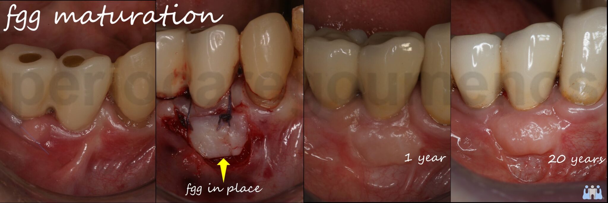 Free Gingival Graft placement on tooth #44