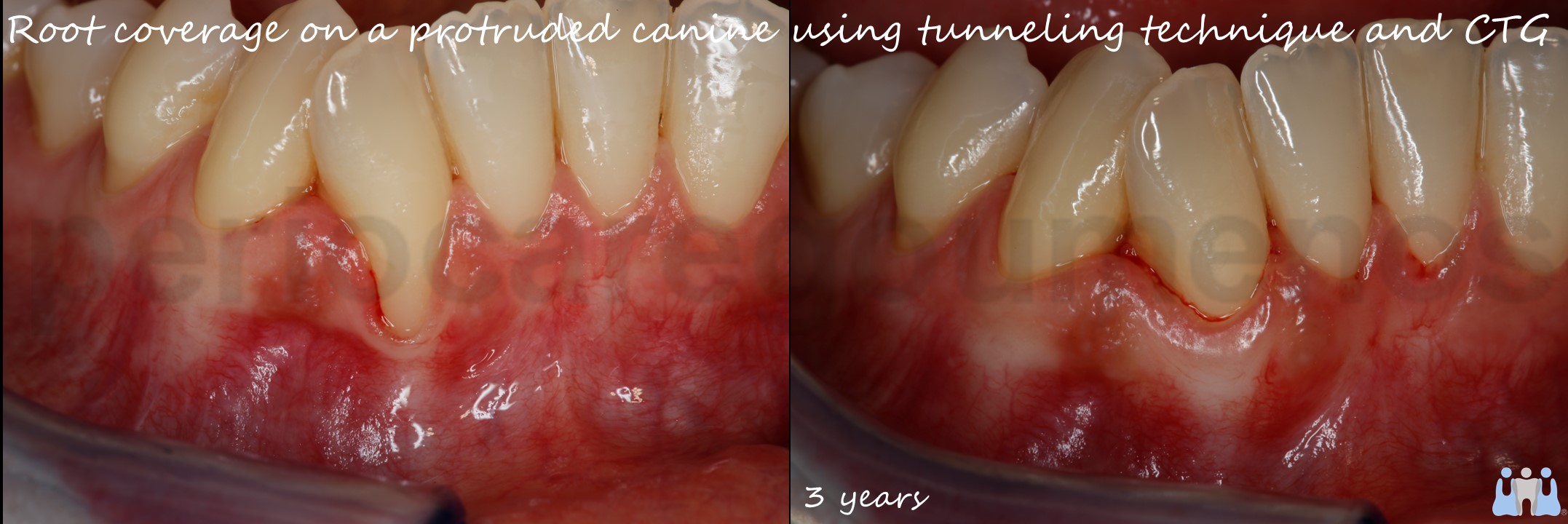 Root coverage on a protruded lower canine