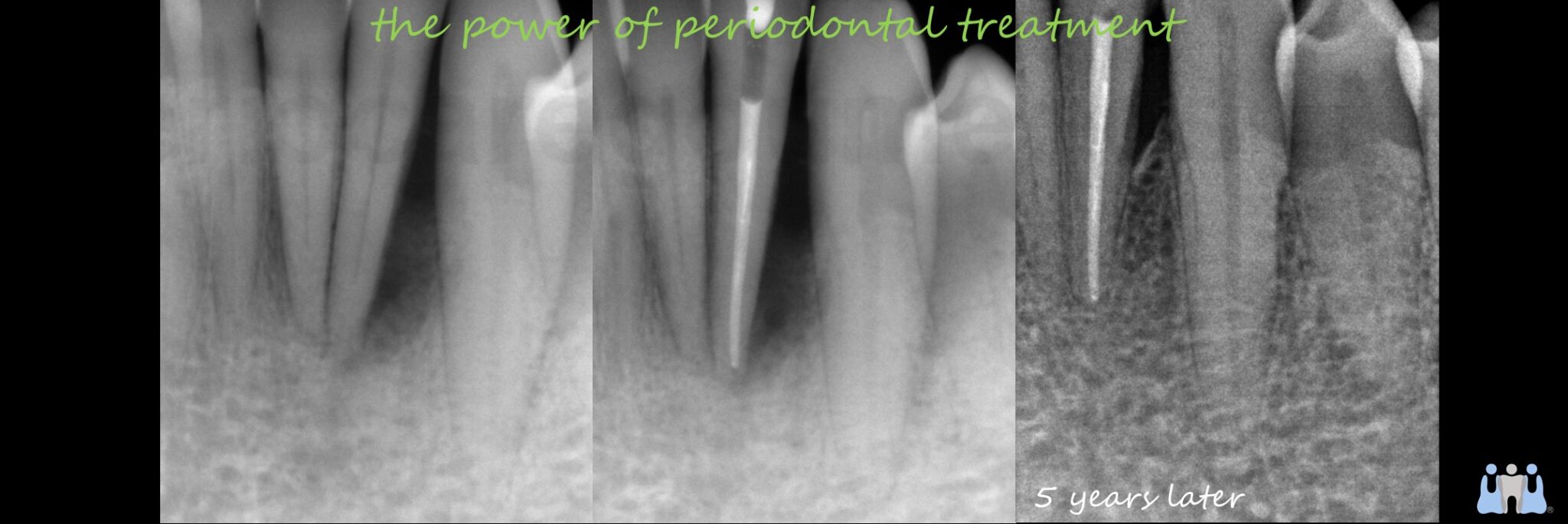 Title:Use of Emdogain in a lower lateral incisor with severe periodontal destruction.