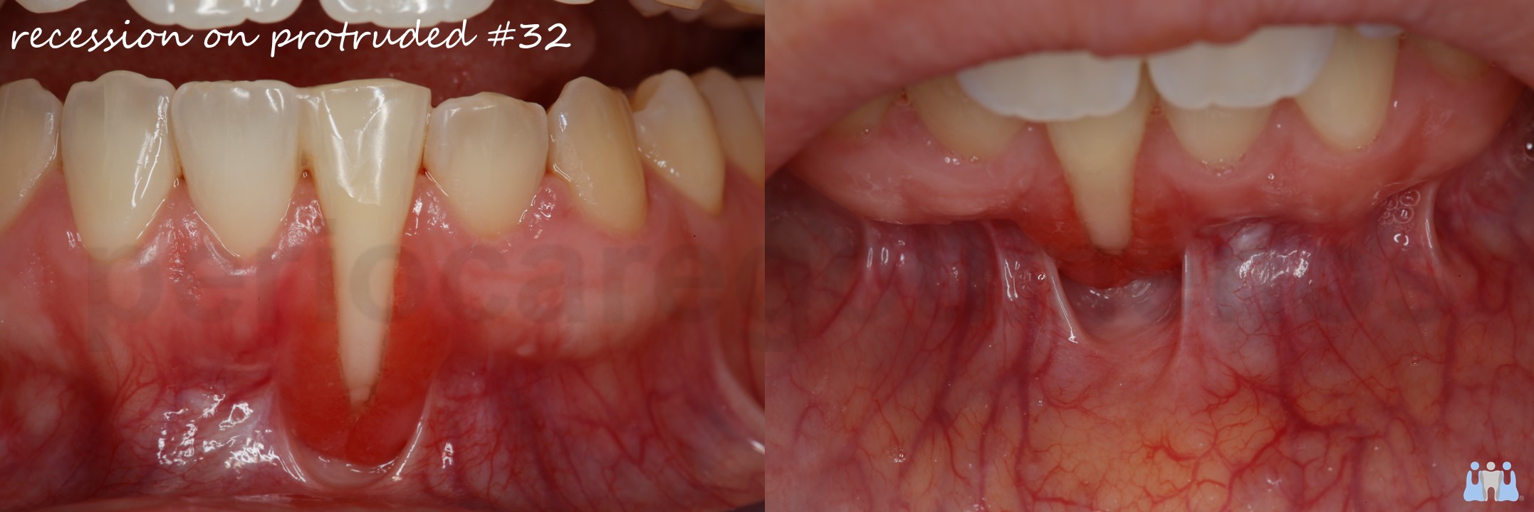 Partial Coverage of a lower buccaly protruded root using a Free Gingival Graft